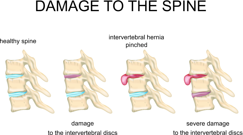 Hernia de disc: simptome, diagnostic şi tratament - Move&Flex